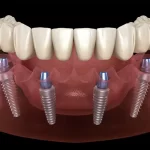 all-on-four-todos-os-dentes-em-quatro-implantes-sem-enxerto